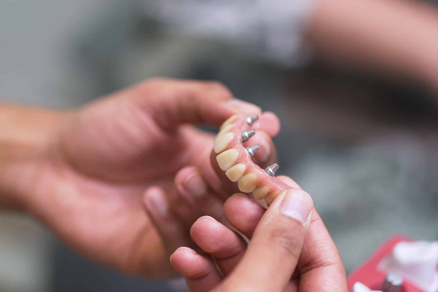 dental implants - preventing bone loss