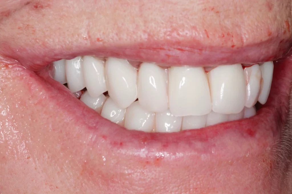 dentist in colchester -dental implant - 2 - after