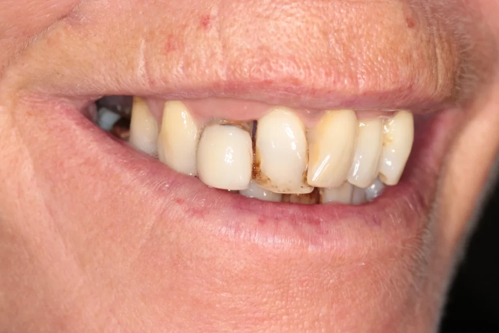 dentist in colchester -dental implant - 2 - before