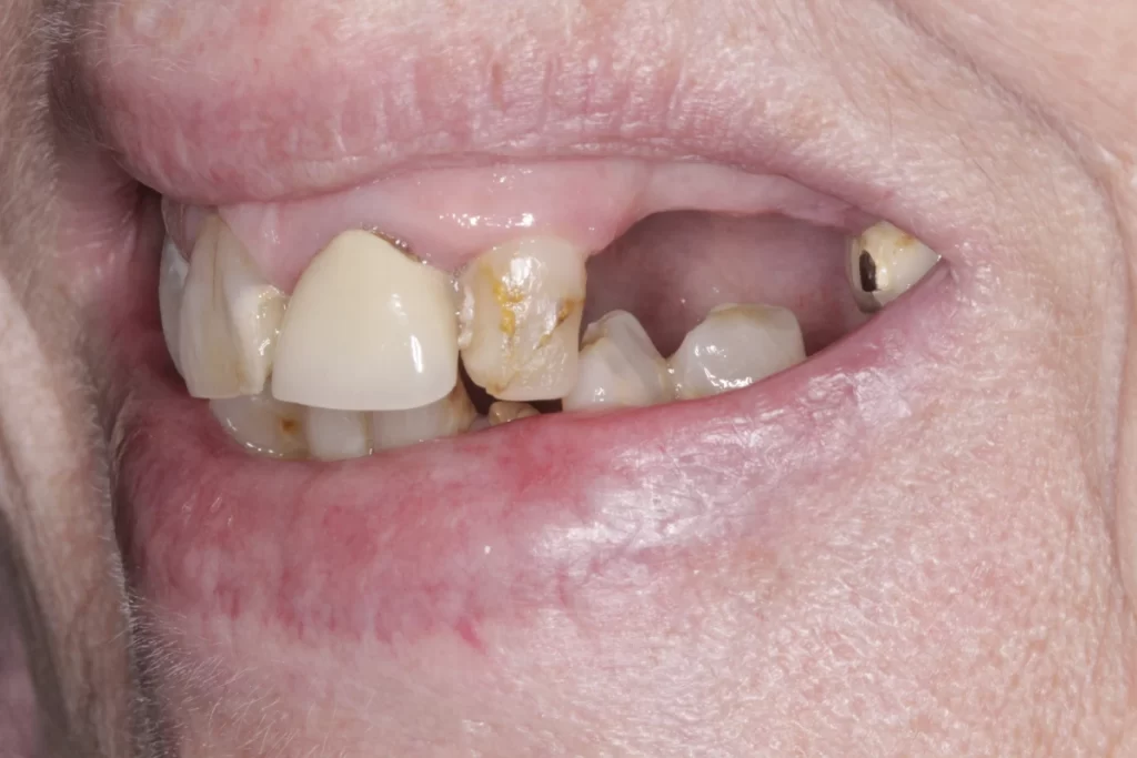 dentist in colchester - dental implant treatment - before