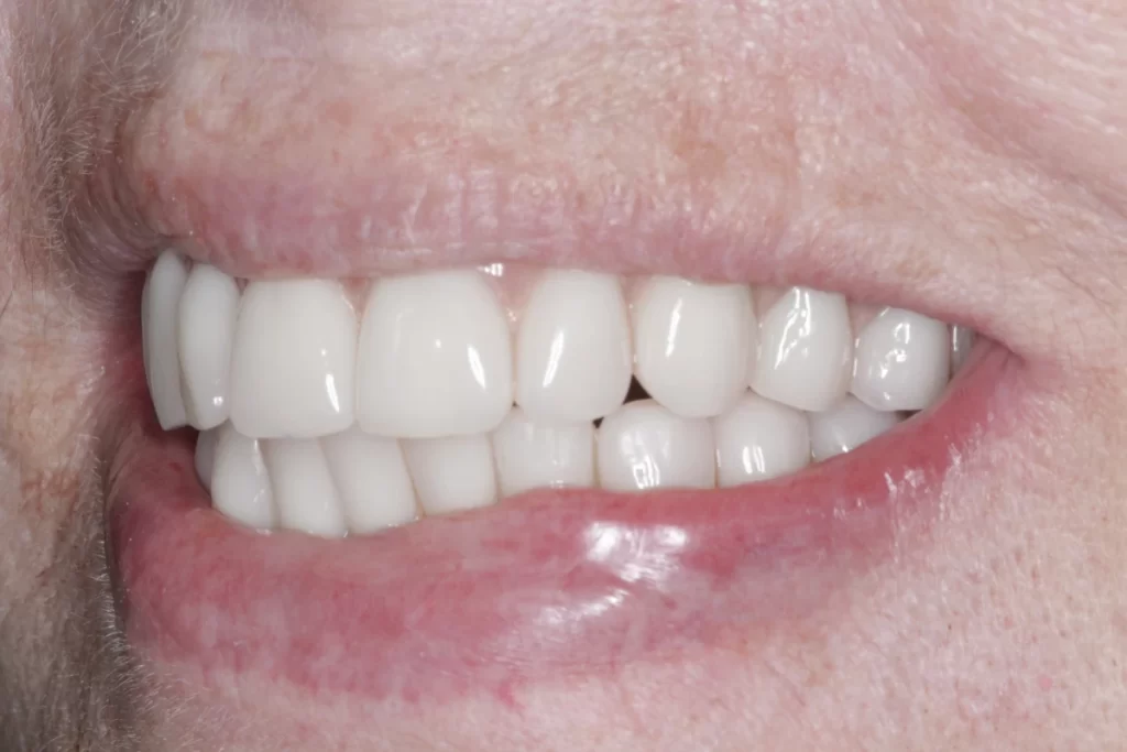 after - how long do tooth implants last