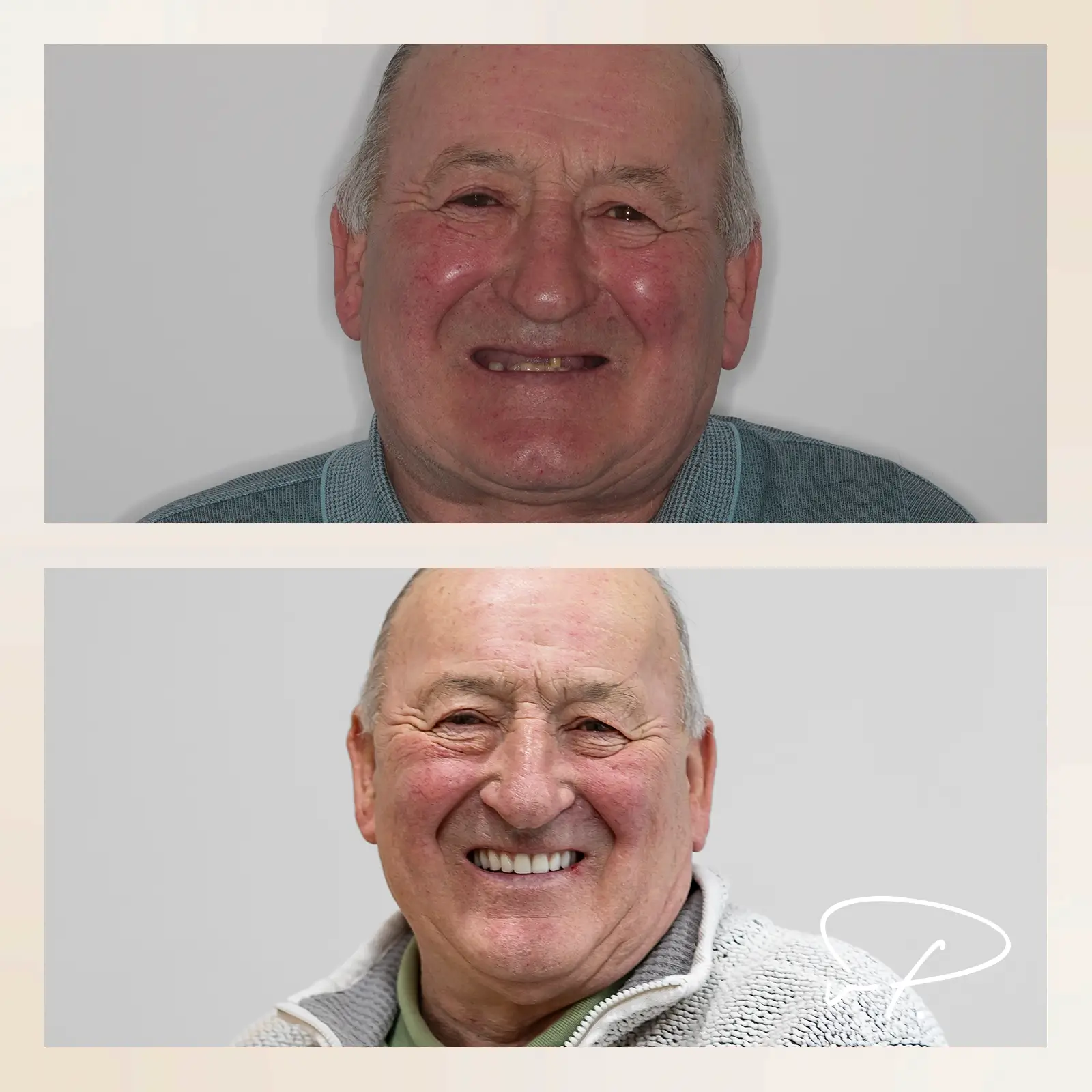 patrick before and after implant treatment - vp implantology